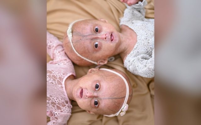 Morre Elis, uma das gêmeas de Roraima com progéria, síndrome rara do envelhecimento precoce