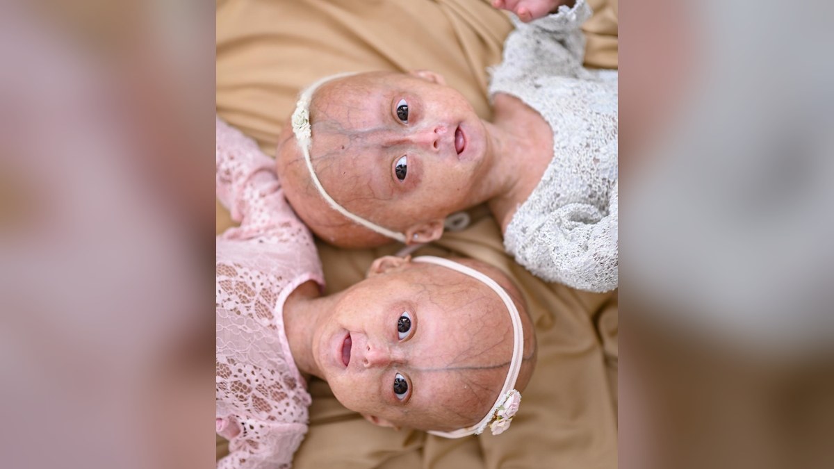 Morre Elis, uma das gêmeas de Roraima com progéria, síndrome rara do envelhecimento precoce