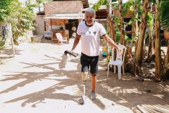 Líder comunitário de Boa Vista consegue prótese com apoio da DPE-RR